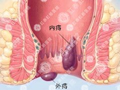 如何治好痔疮