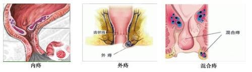 女性痔疮图片