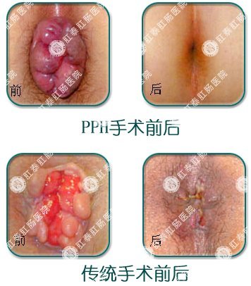 痔疮垫什么原理_轻微的痔疮长什么样子(2)